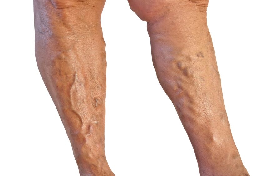 Alleviate Discomfort With A Varicose Veins Doctor in The Bay Area