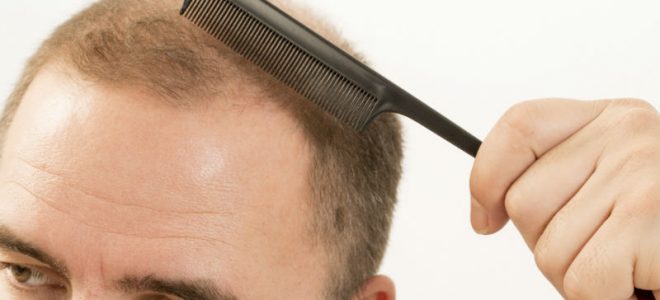 There Is Good News for NYC Residents Dealing With Hair Loss