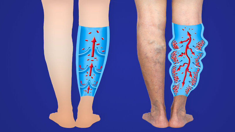 Get Back On Your Feet With Varicose Vein Treatment In New York