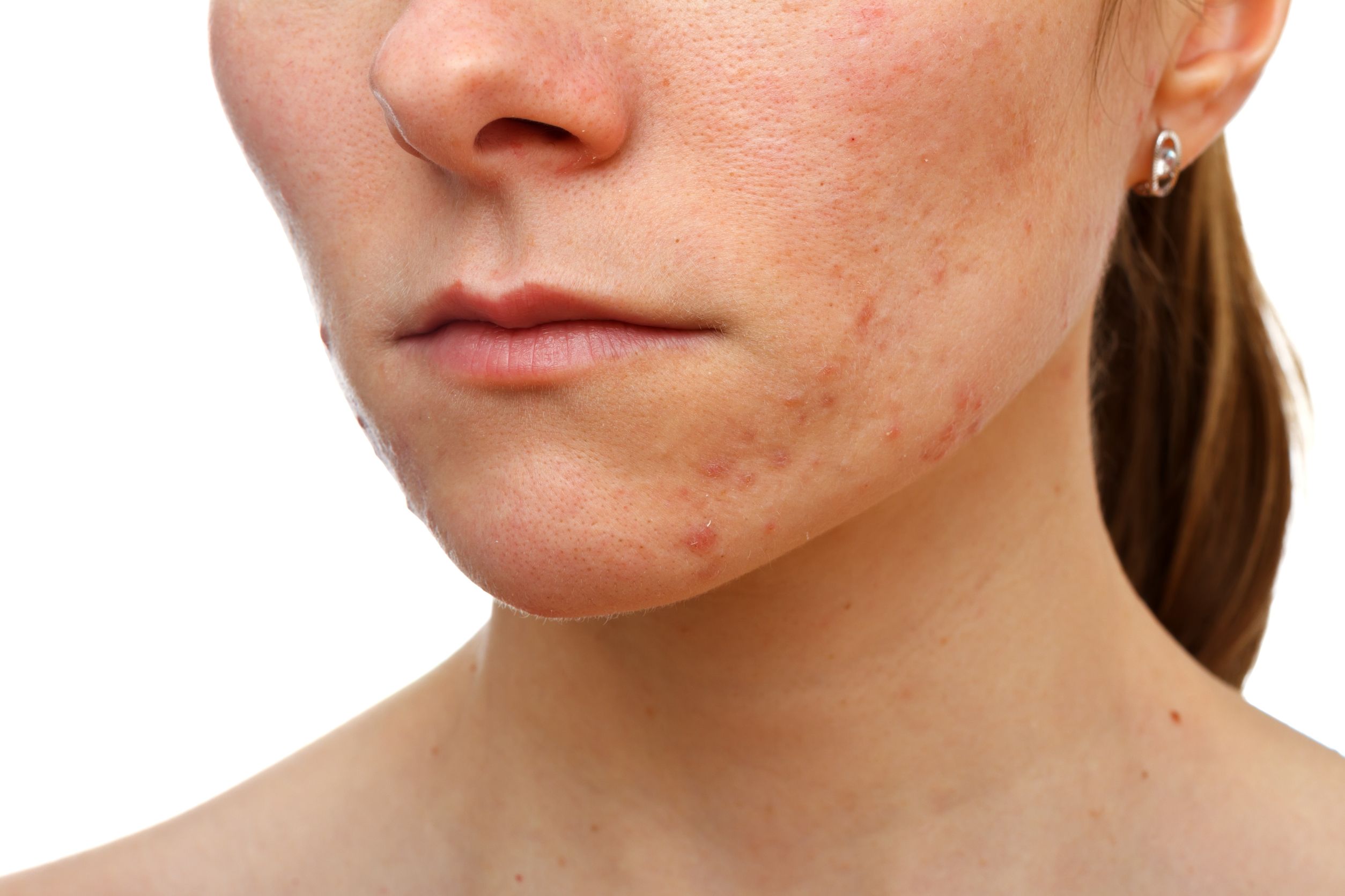 Effective Skin Care Treatment for Acne in Spokane, WA: Your Path to Clear Skin