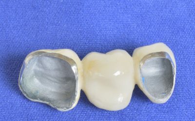 The Advantages Of Dental Crowns